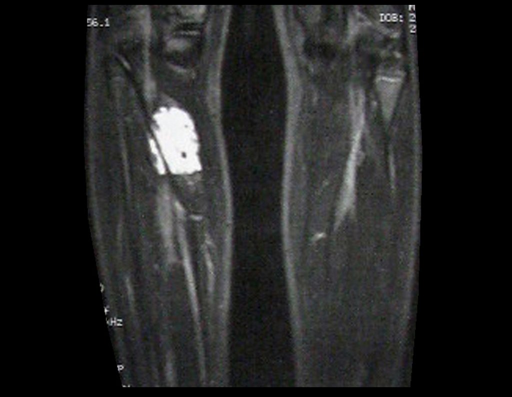 Figura 9: Rm coronal T2, visualizamos lesão de alto sinal no ventre muscular medial do músculo sóleo na perna direita.