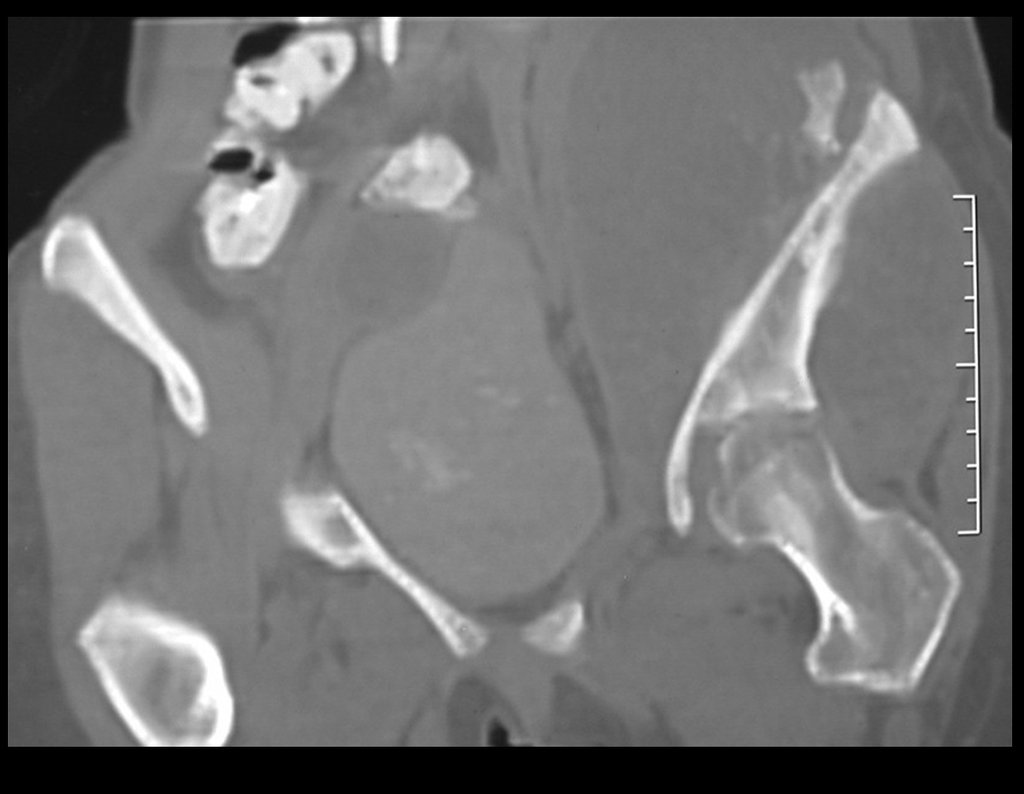 Figura 19: Tomografia coronal, densidade para osso, com grande tumor acometendo o ilíaco esquerdo.