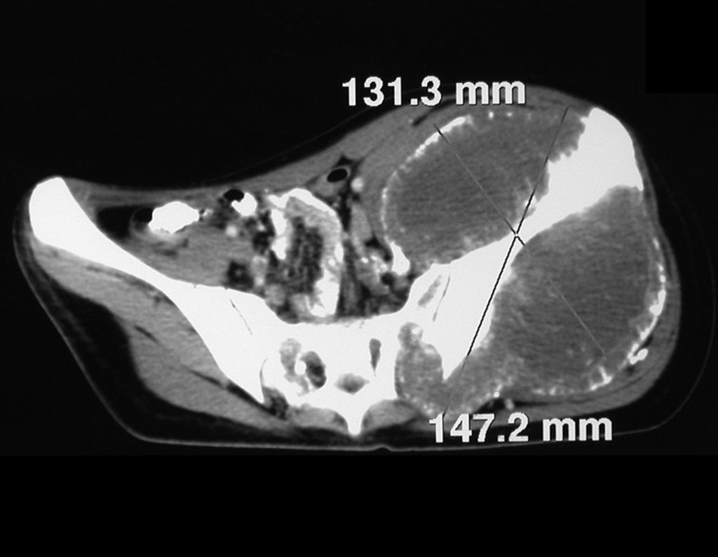 Figura 18: Tomografia axial, densidade para tecidos moles, grande tumor acometendo o ilíaco esquerdo.