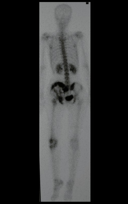 Figura 7: Cintilografia óssea, fase tardia, posterior, com hipercaptação no ilíaco direito.