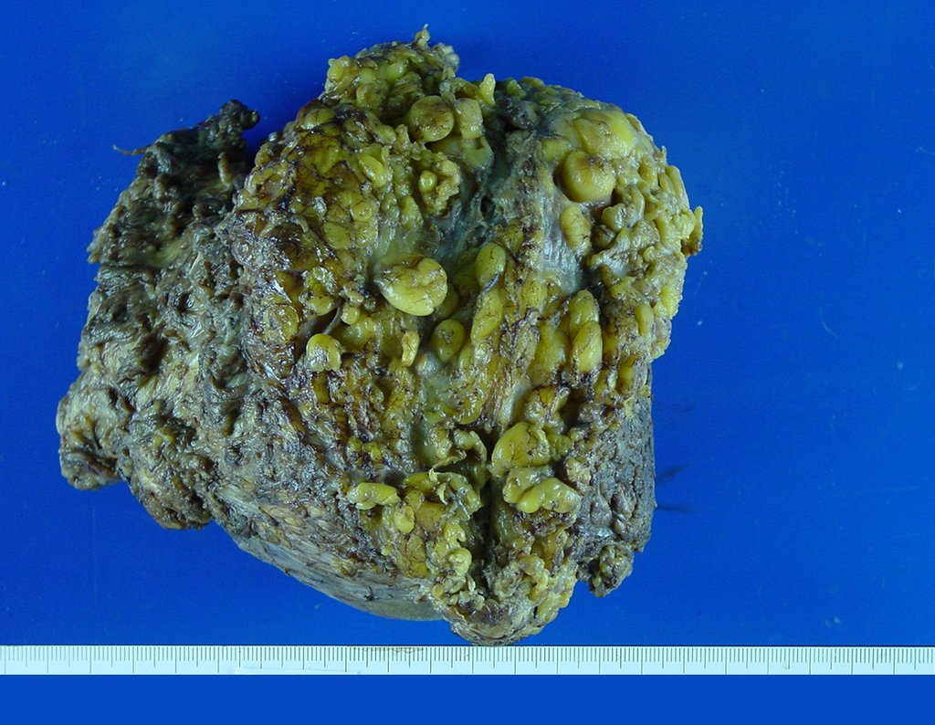 Figura 40: Aspecto da peça cirurgia com tecidos moles macroscopicamente sadios, envolvendo o tumor.