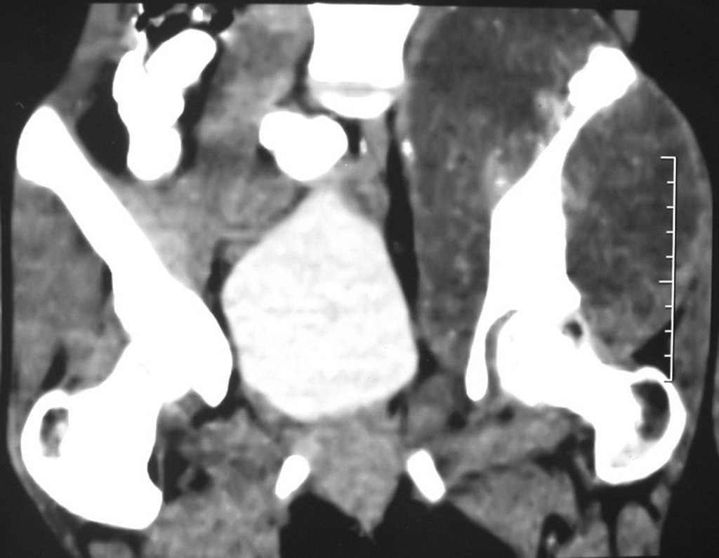 Figura 20: Tomografia coronal, densidade para tecidos moles, com grande tumor acometendo o ilíaco esquerdo.