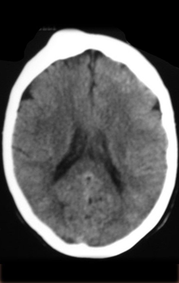 Figura 6: Tomografia axial do crânio com lesão acometendo as duas tábuas, com abaulamento maior da cortical externa.