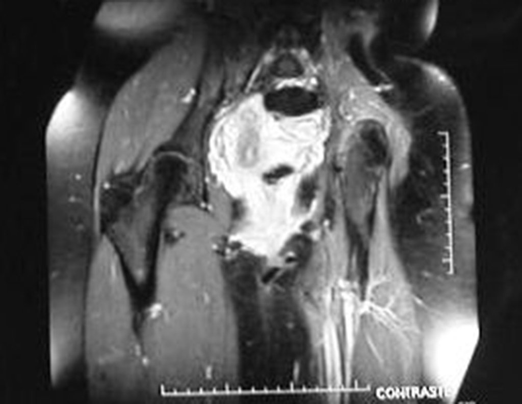 Figura 66: RM coronal T1 Spir, com contraste, após dois anos da cirurgia.