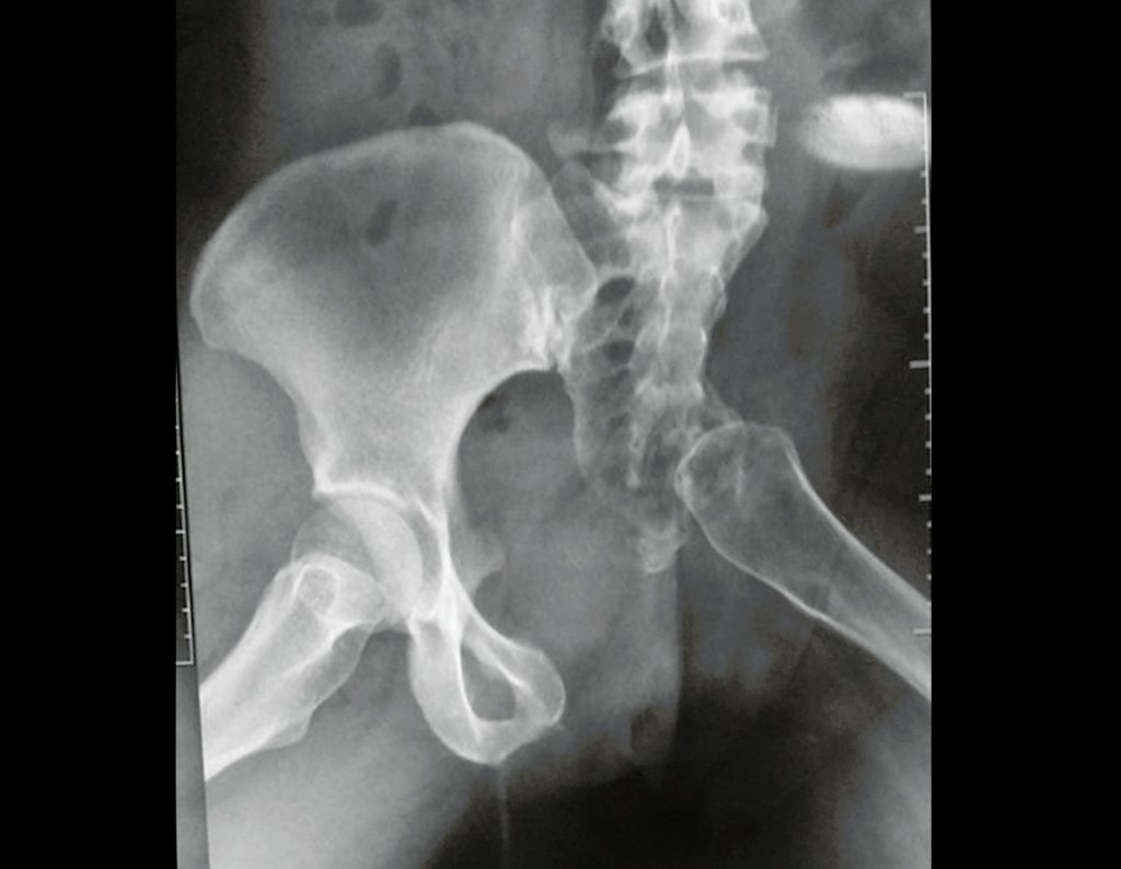 Figura 96: Radiografia da bacia em Lowenstein, em 16/06/2015.