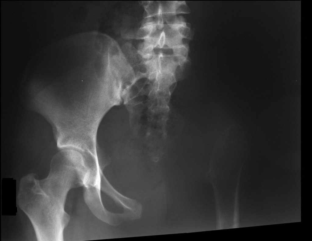 Figura 57: Radiografia do pós-operatório de um ano e seis meses. O membro inferior esquerdo parece flutuar, mas na realidade existe uma fibrose cicatricial que apoia o membro e impede maior ascensão.