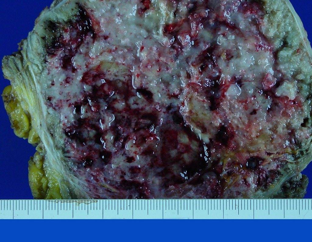 Figura 44: Em maior aumento, detalhando o aspecto macroscópico deste condrossarcoma.