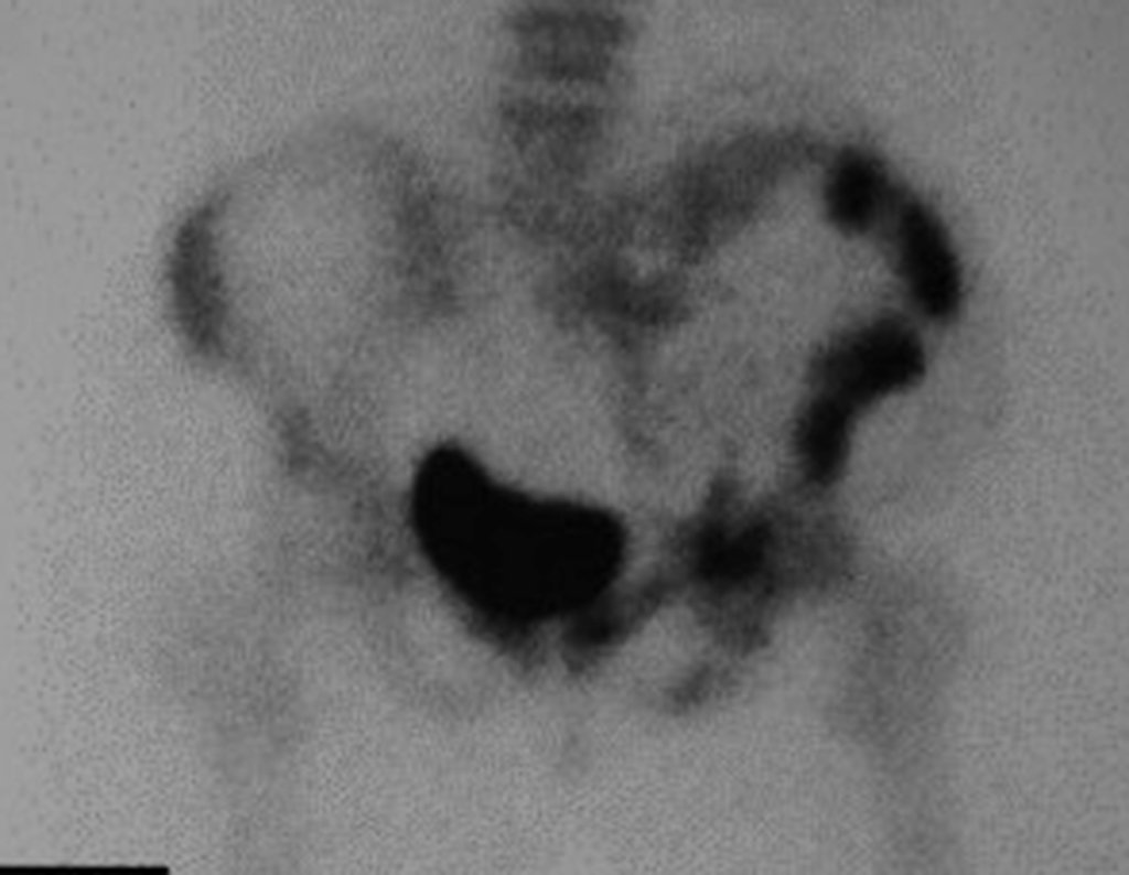 Figura 8: Cintilografia localizada da bacia, detalhando o comprometimento do ilíaco direito.