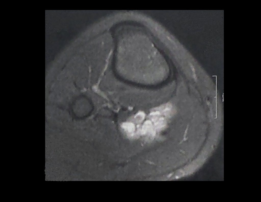 Figura 10: Rm axial T2 evidencia lesão de alto sinal, no ventre muscular do soleo medial direito, com aspecto de “cacho de uva”.