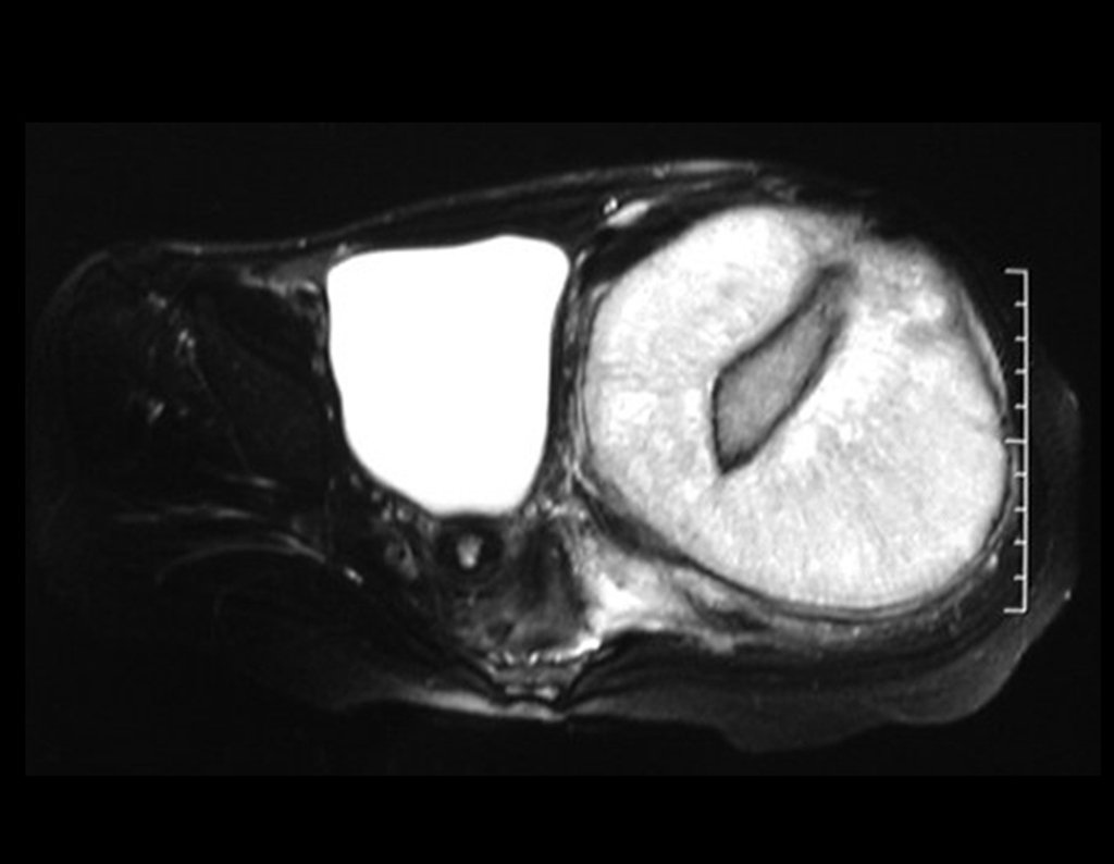 Figura 11: RM axial alto sinal em T2, com grande tumor extracortical, comprometendo a tábua interna e a tábua externa do ilíaco direito.