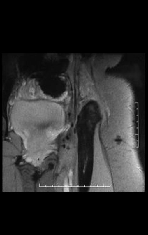 Figura 62: RM coronal T2, após dois anos da cirurgia.