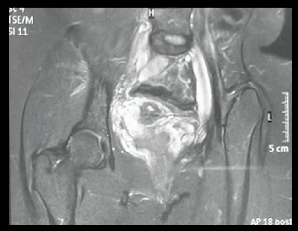 Figura 101: RM da pelve, coronal com saturação de gordura, com as alterações adaptativas do MIE, em 16/06/2015.