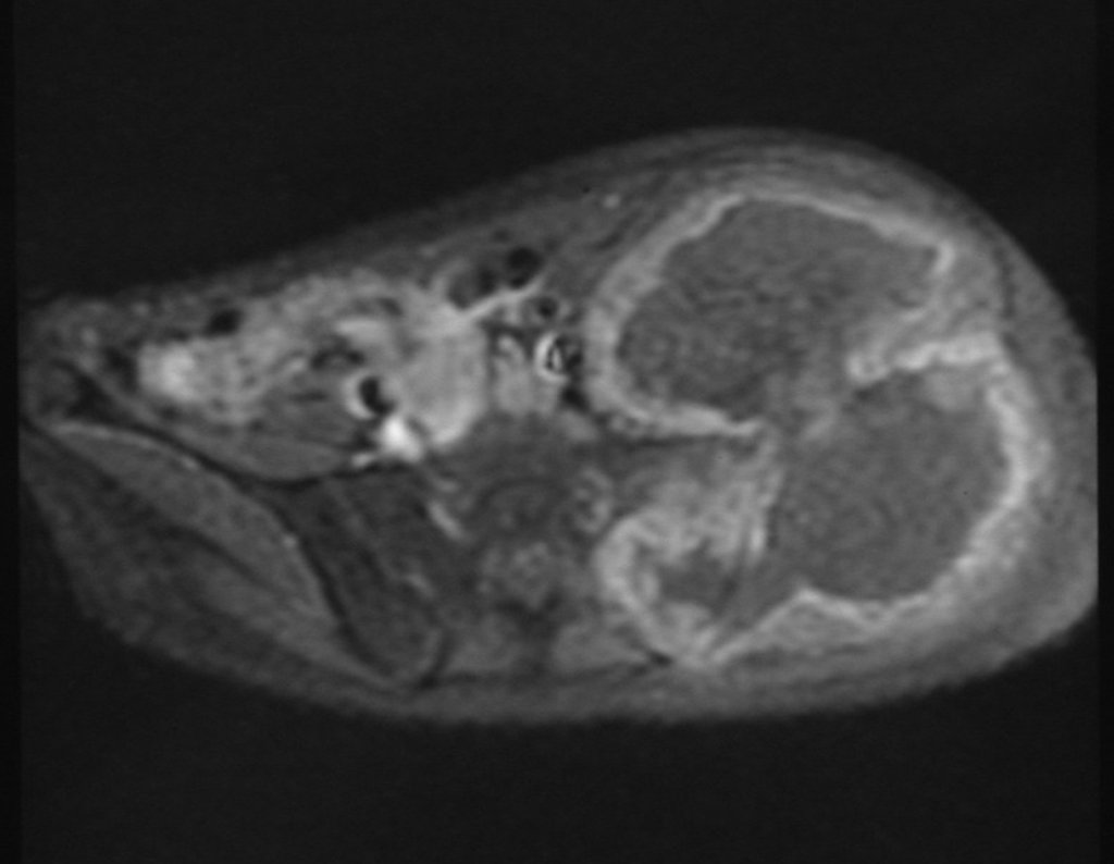 Figura 15: Outro corte de axial T1, com saturação de gordura e contraste, evidenciando espessa área de captação (alto sinal) devido à capa de cartilagem neoplásica maligna, ao redor da lesão (com baixo sinal).