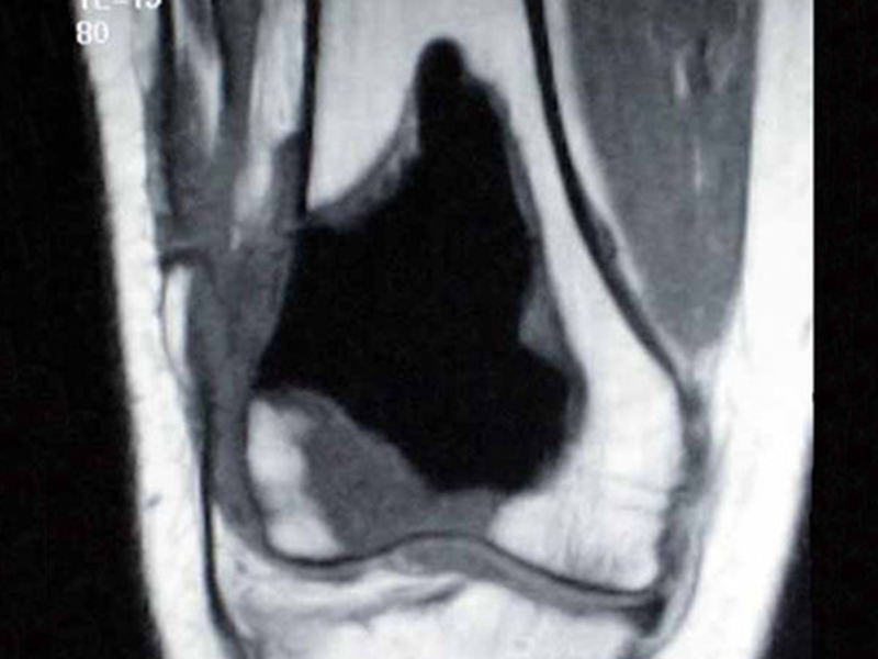 Condrosarcoma del Fémur