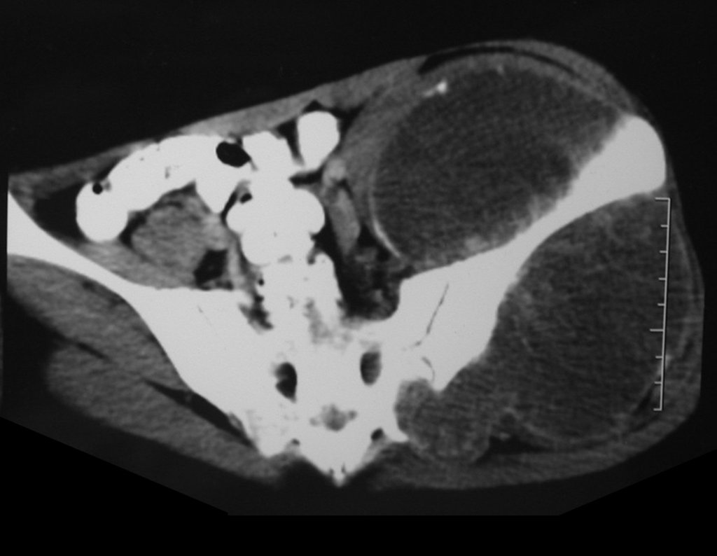 Figura 13: RM axial T1 spir, com supressão de gordura, evidenciando reação periosteal em espículas e focos de calcificação.