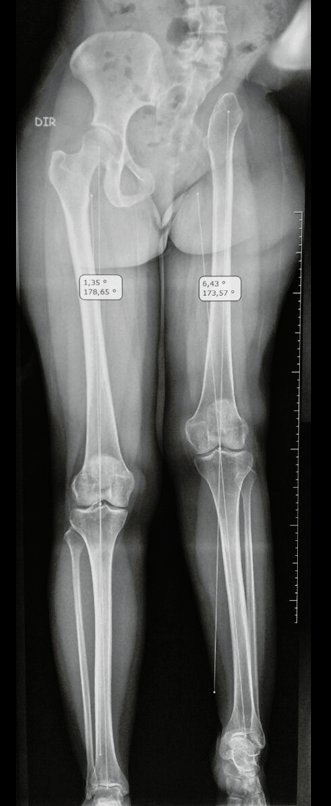 Figura 93: Escanometria mostrando o encurtamento do MIE de 5,08 cm, em 12/05/2015.