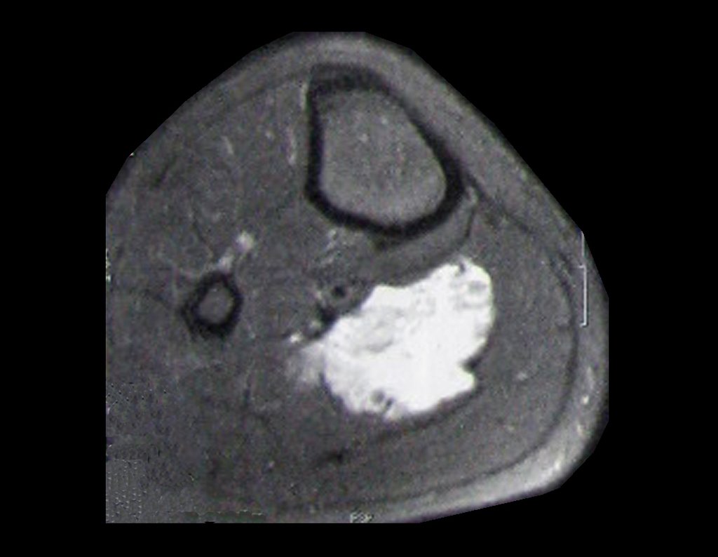 Figura 12: Rm axial T2, com lesão de alto sinal no ventre muscular do sóleo medial direito, evidenciando a proximidade do tumor com o feixe vascular tibial posterior.