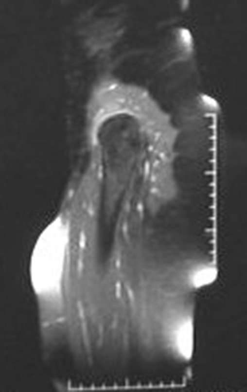 Figura 63: RM sagital T1 Spir, com contraste, após dois anos da cirurgia.