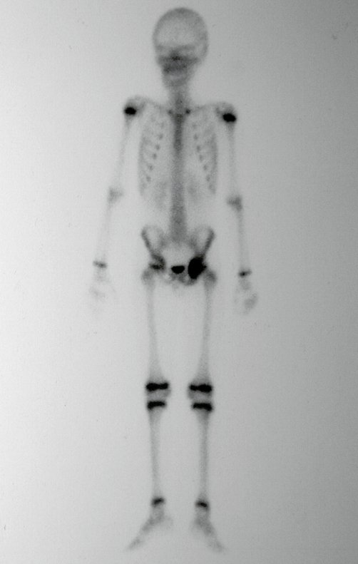 Figura 5: Cintilografia pré operatória, vista de frente, evidenciando grande captção na região do Ísquio esquerdo.