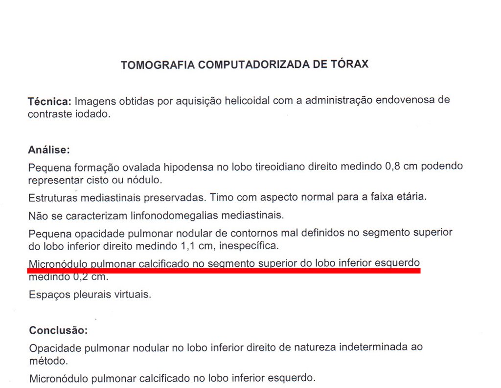 Figura 13; Laudo da tomografia de tórax revelando nódulo calcifiado no segmento superior do lobo inferior esquerdo, cicatricial.