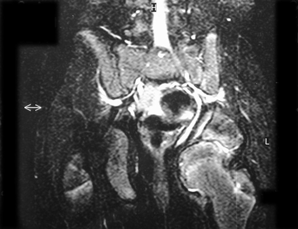 Figura 62: Rm cor T2, subluxação medial do quadril esquerdo e deformidade acetabular.