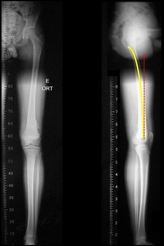 Figura 28: Eescanometria em perfil destacando o antecurvatum. Projeção do trajeto falso que a haste reta da prótese ocasiona.