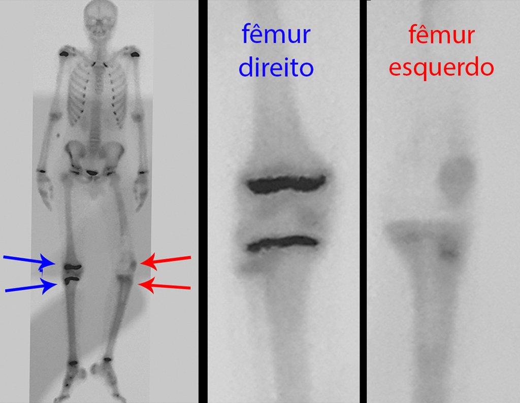 Figura 81: Cintilografia evidenciando fises férteis à direita, setas azuis, ausencia na projeção da prótese femoral e fechada na projeção da tíbia do lado esquerdo, setas vermelhas.