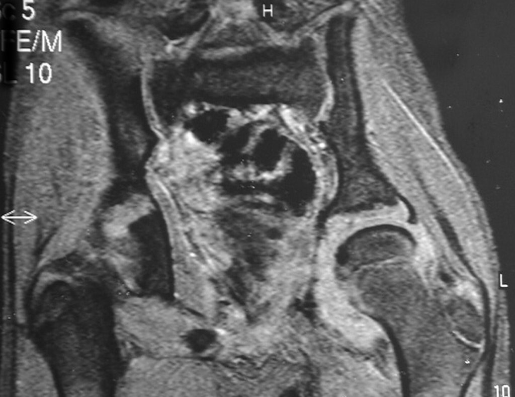 Figura 65: Rm cor ffe, sem sinais de calcificação.