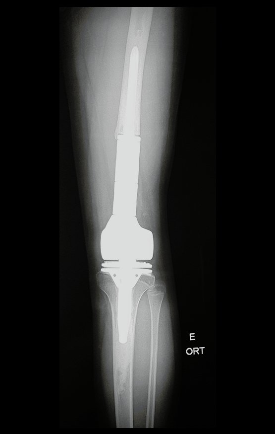 Figura 89: Radiografia pós operatória, após um ano e três meses, da ressecção e reconstrução com endoprótese.