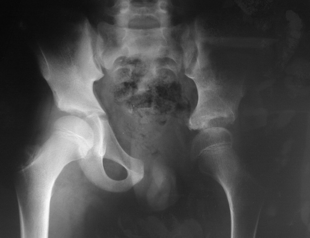 Figura 40: Radiografia de bacia frente, após dois anos.