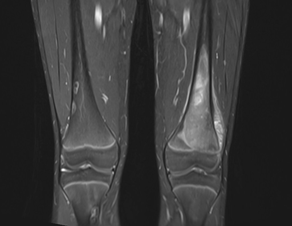 Figura 4: Rm centrada na lesão, evidenciando o comprometimento da metade lateral da placa de crescimento do fêmur esquerdo. Na metáfise distal do fêmur direito podemos observar duas lesões na face lateral e na metáfise proximal da tíbia deste mesmo lado vemos uma lesão na cortical medial.