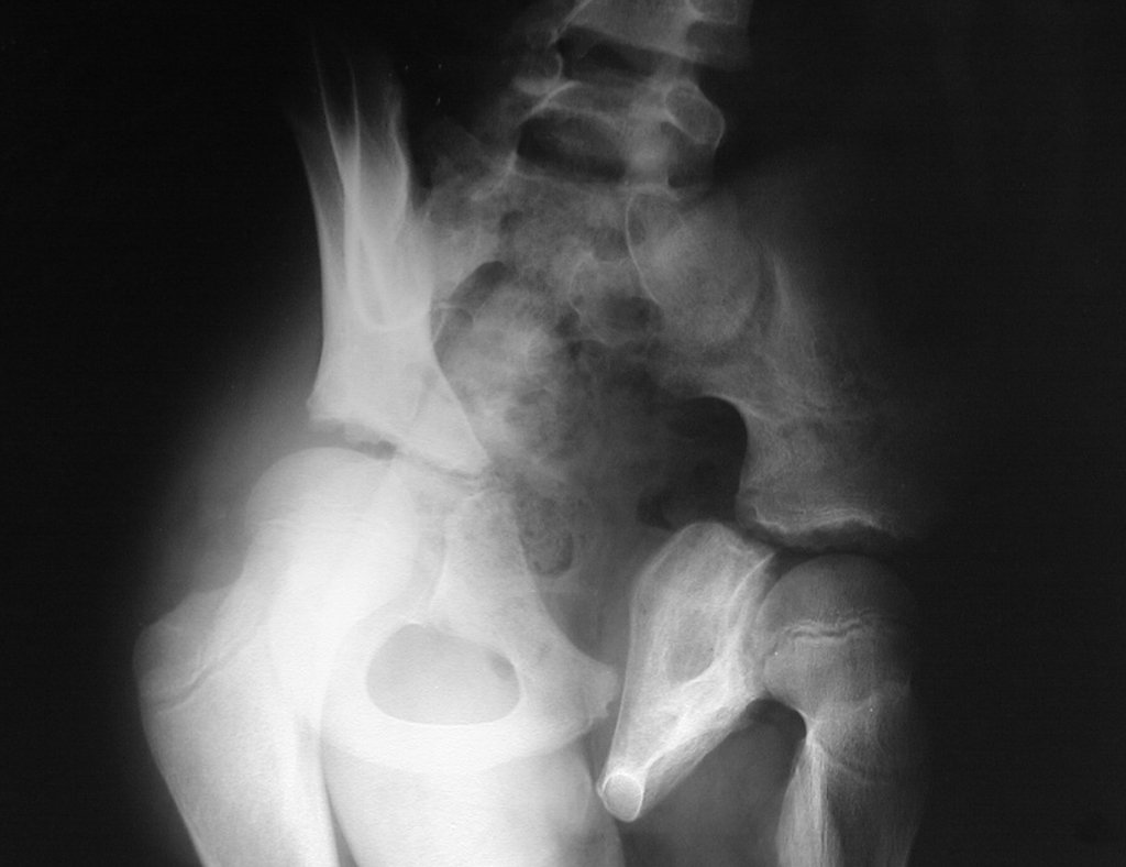 Figura 17: Radiografia de bacia em alar, com completa mineralização da lesão, revelando excelente resposta local.