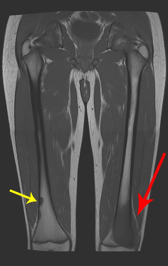 Figura 1: Lesão metafisária com baixo sinal em T1, comprometendo a cortical lateral e a placa de crescimento do fêmur esquerdo, seta em vermelho. Na metáfise femoral direita observamos duas lesôes na metáfise, próximo a cortical lateral.