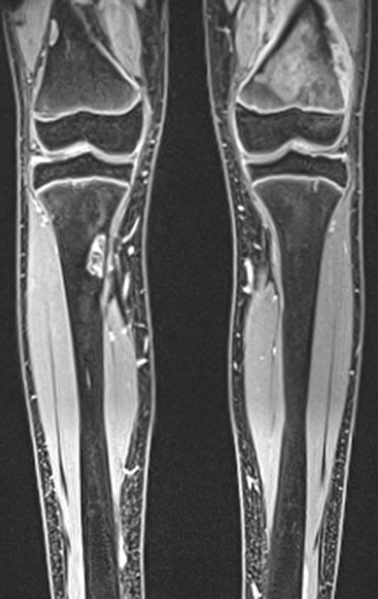 Figura 7: Rm coronal pós contraste.