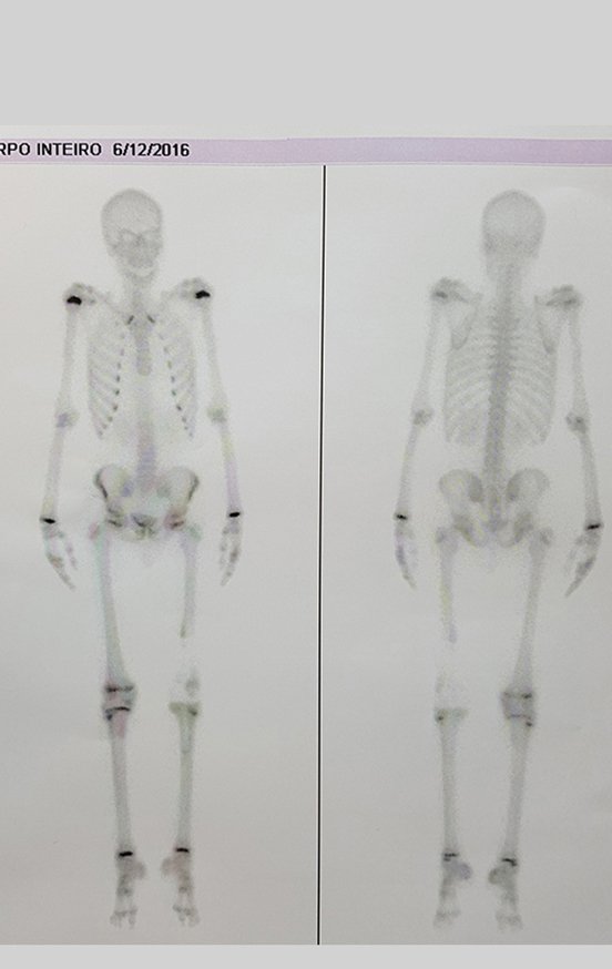 Figura 86: Cintilografia revelando apagamento da captação das placas de crescimento do fêmur e da tíbia contralateral, devido à epifisiodese