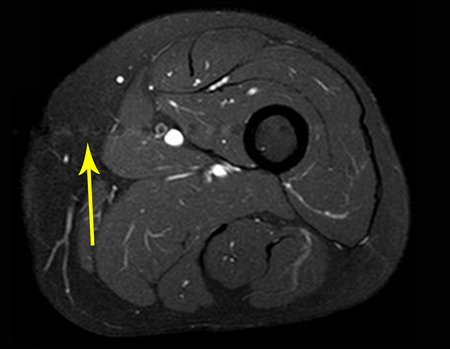 Figura 79: Rm axial após um ano da cirurgia, sem sinal de recidiva. A seta amarela assinala a cicatriz do acesso cirúrgico.