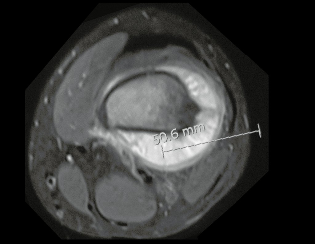 Figura 19: Rm axial, com a delimitação do local onde queremos colher material. Na lesão extra-cortical, no septo da inserção posterior da fascia muscular.