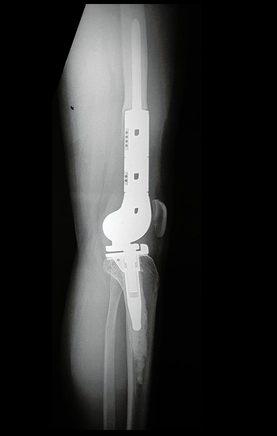 Figura 90: Radiografia perfil, em 10/03/2017.