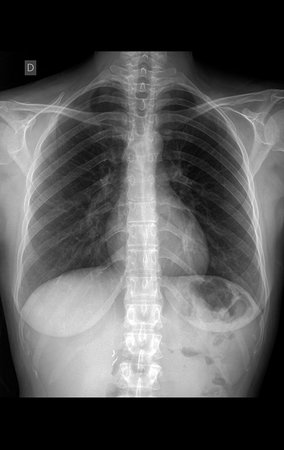 Figura 15: Radiografia de tórax PA, normal.