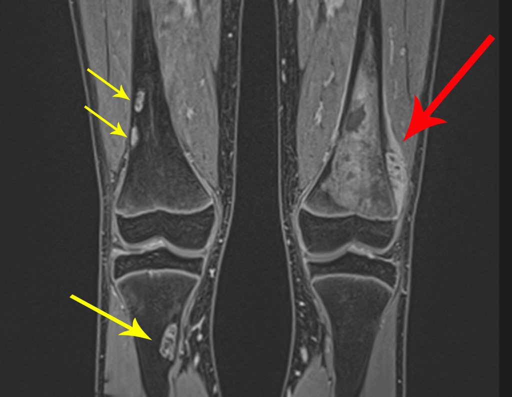 Figura 6: Rm coronal T1, contraste. A seta em vermelho assinala a lesão heterogênea, agresssiva, com áreas de rarefação e áreas mais densas. No lado direito as setas amarelas destacam as lesões pseudo neoplásicas, já referidas.