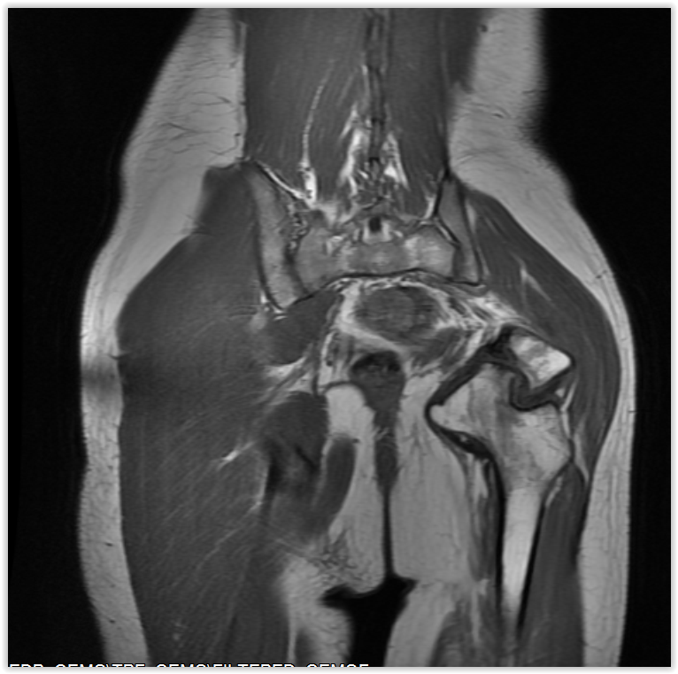 Figura 92: Rm sag T1, após 13 anos, apoio parcial e deformidade da cabeça femoral, indolor.