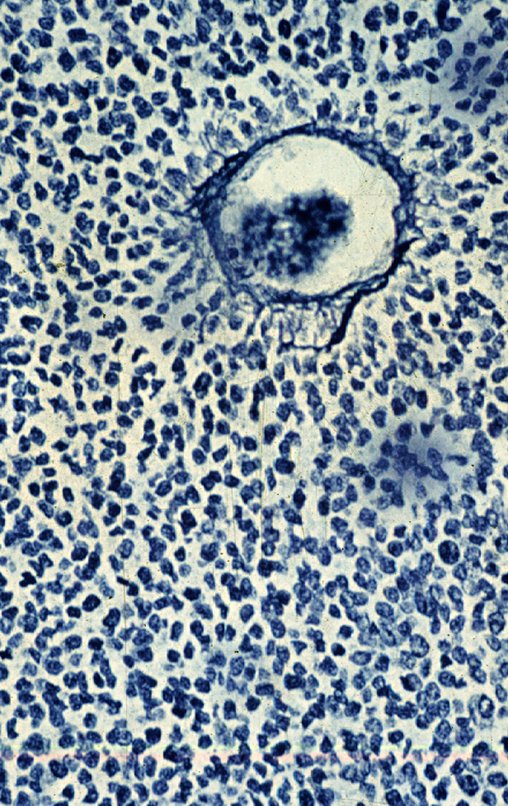 Figura 11: Lâmina de sarcoma de Ewing, reticulina negativa, onde se observa as pequenas células redondas soltas. Observa-se a presença de reticulina apenas ao redor dos vasos.