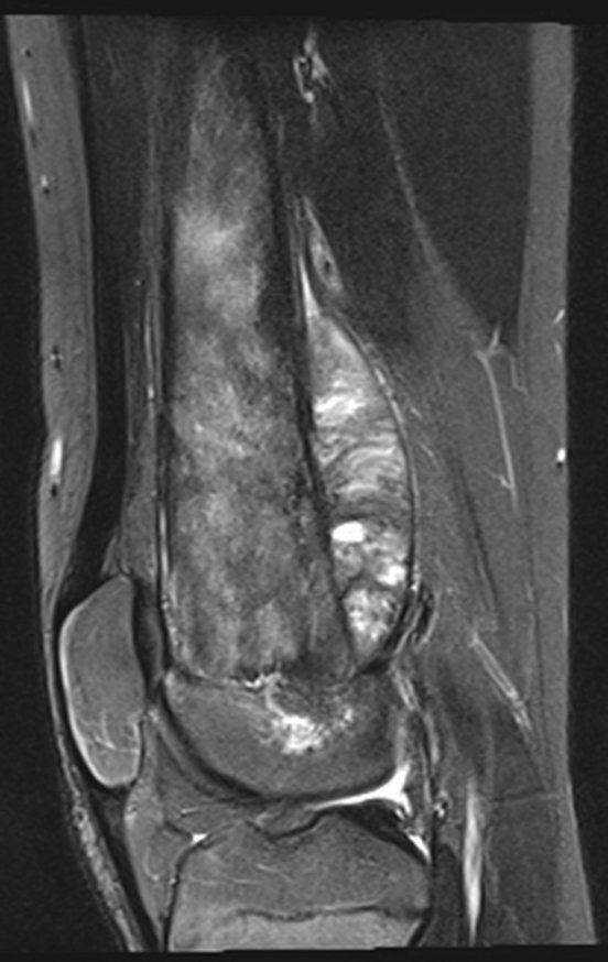 Figura 32: Rm sagital, pós contraste, pós quimioterapia neoadjuvante, revelando a extensão do tumor , que compromete a placa de crescimento e a epífise femoral;