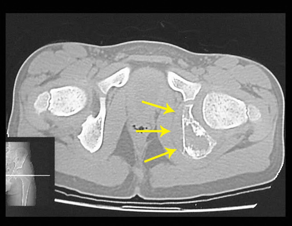 Figura 19: Tomografia pós Qt, densidade para tecido ósseo, as setas mostram a evidente diminuição do volume tumoral extra-cortical.