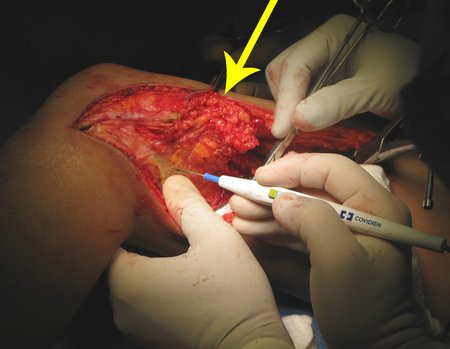 Figura 42: Dissecção contornando posteriormente a lesão, "enchergando" com os dedos. A seta amarela destaca a pele e o trajeto da biópsia rebatidos, sendo ressecados juntamente com o tumor.