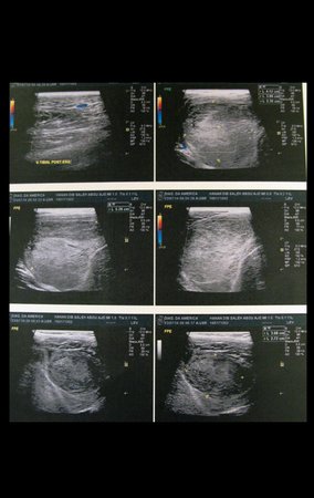 Figura 4: Ultrasonografia da coxa esquerda