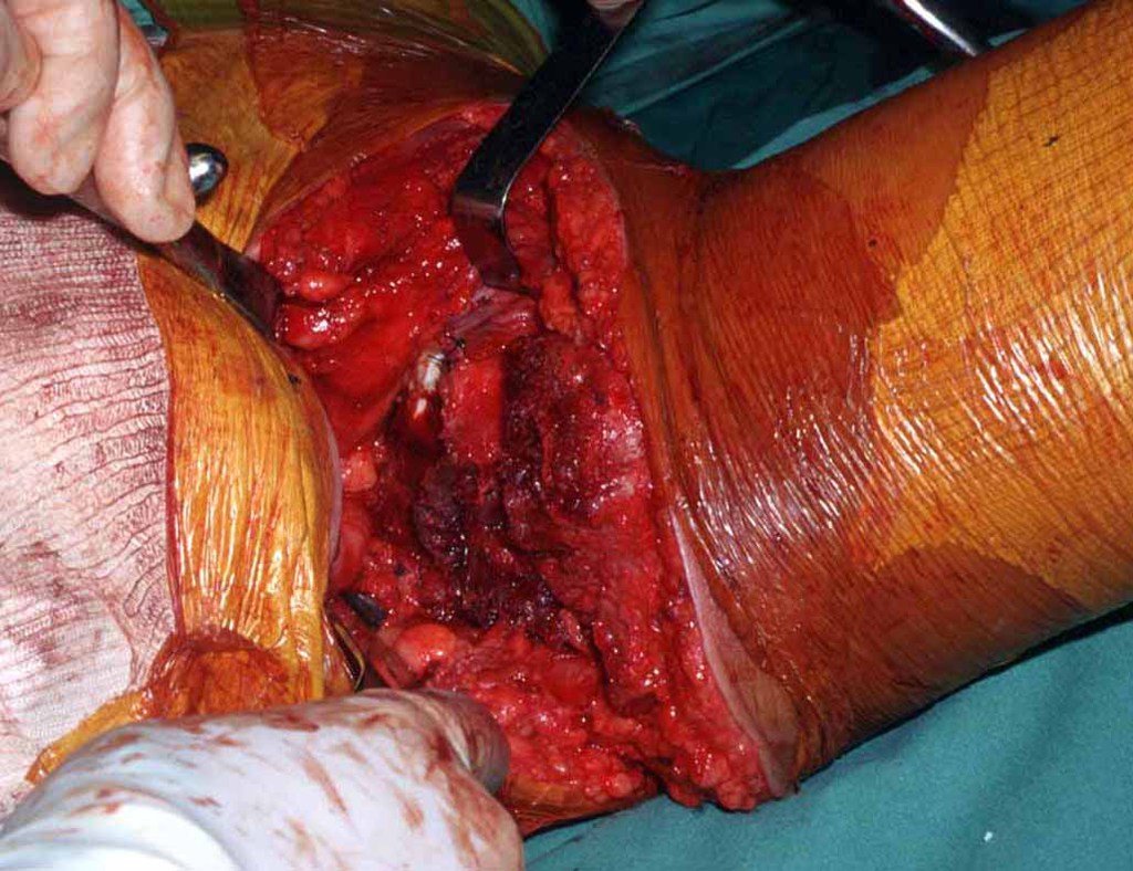 Figura 25: Reconstrução e fechamento medial, suturando os músculos adutores e isquío-tibiais ao redor da porção remanescente do teto acetabular, visando conter a cabeça femoral.