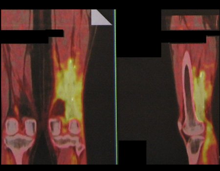 Figura 75: Pet-cet em novembro de 2015, após um ano da cirurgia. Este exame representa a fotografia inicial para o controle comparativo do acompanhamento pós tratamento.