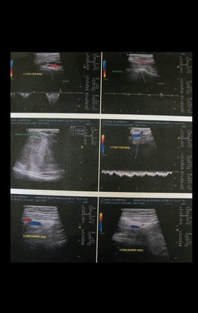 Figura 3: Ultrasonografia da coxa esquerda