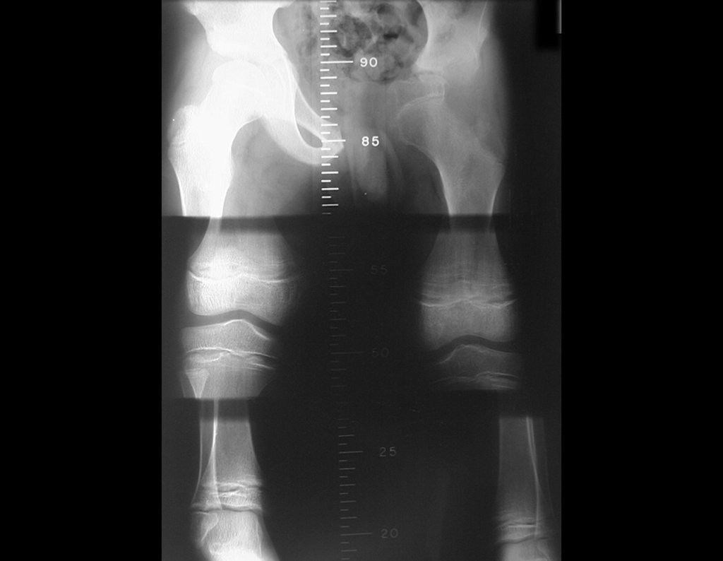 Figura 46: Escanometria de MMII, com discrepância de comprimento, estando o lado operado cerca de 1,75 cm maior que o outro. Isto ocorreu devido a hiperemia próxima a placa de crescimento, ocasionada pela cirurgia.